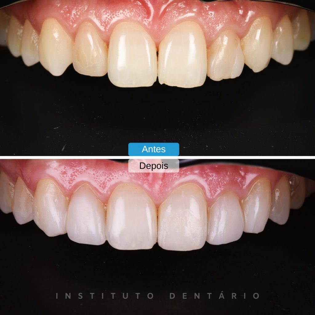 dentisteria branqueamento dentário