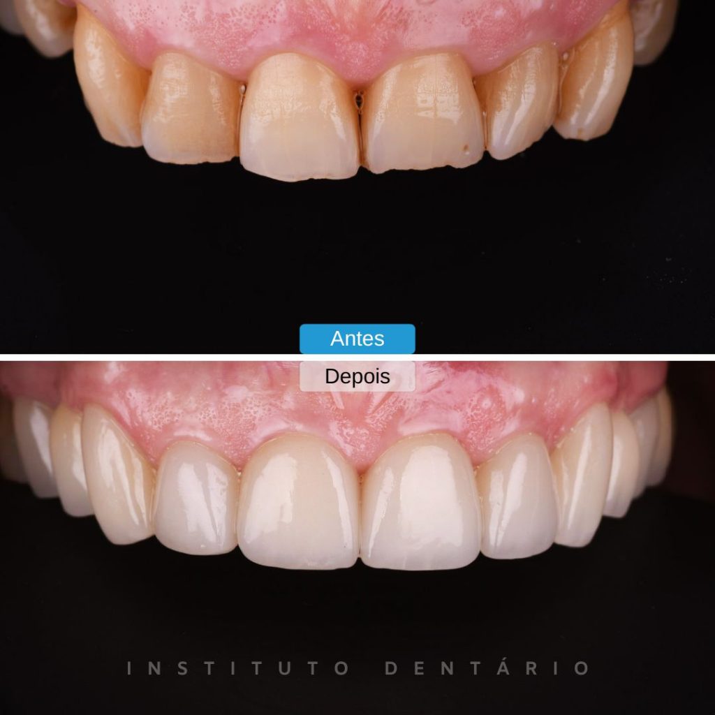 Facetas Dentárias - Caso 2