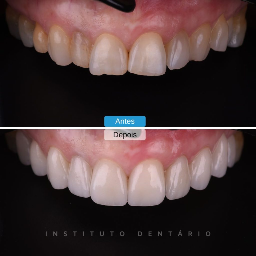 Facetas Dentárias - Caso 4