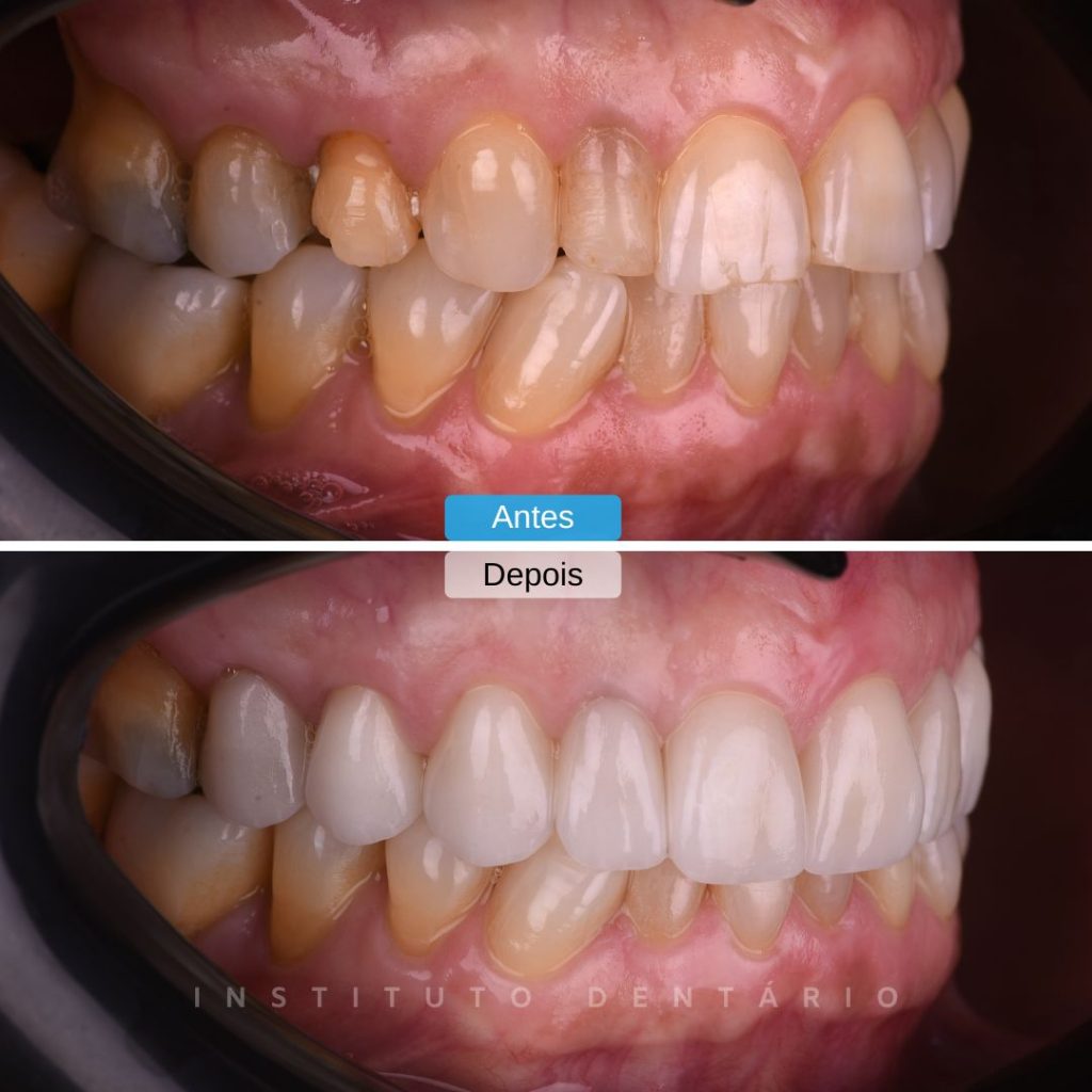 Facetas Dentárias - Caso 4