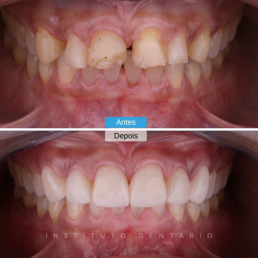 facetas dentárias