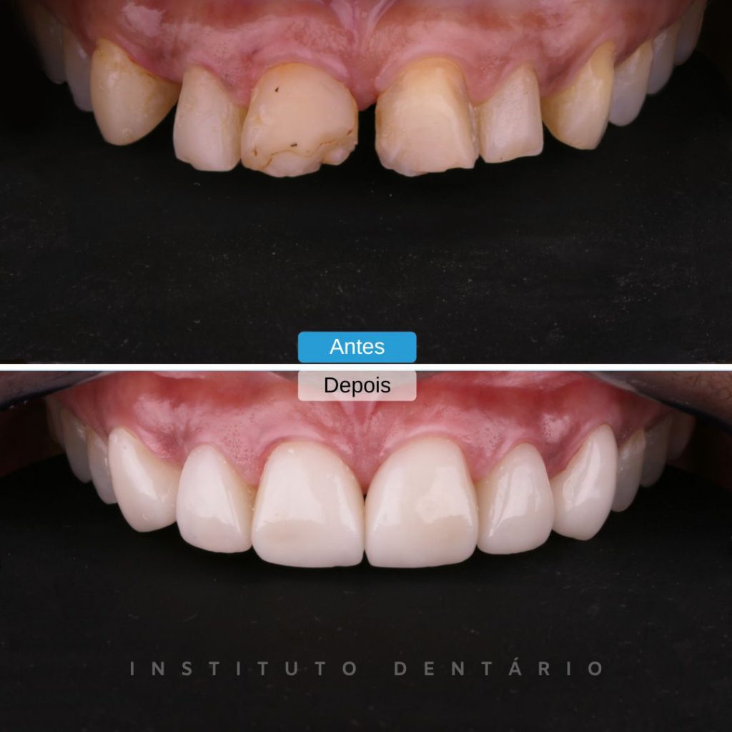 facetas dentárias