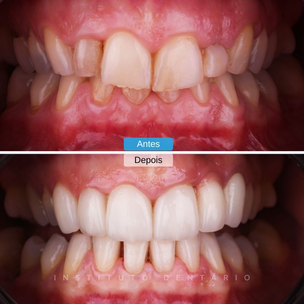 Facetas Dentárias - Caso 7