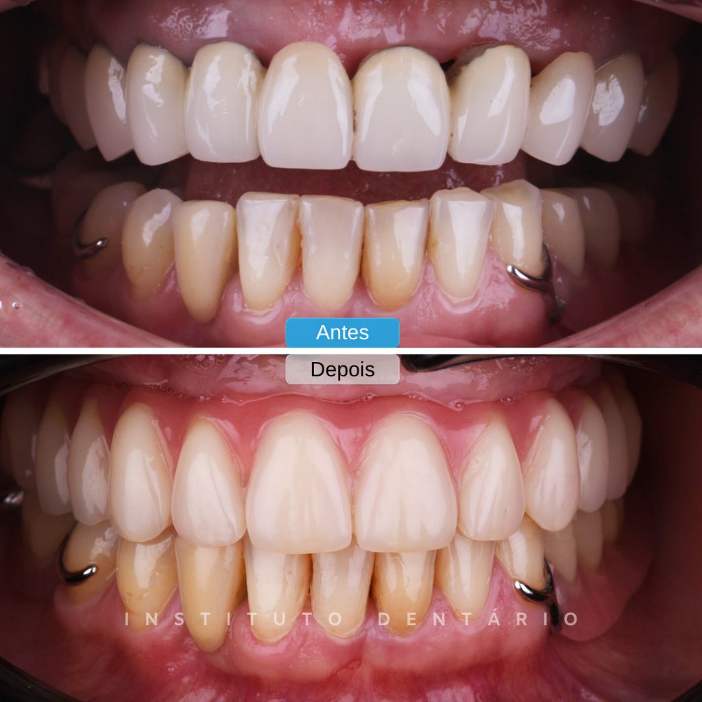 Dentes em 1 dia - Caso 5